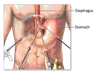 Heller myotomie