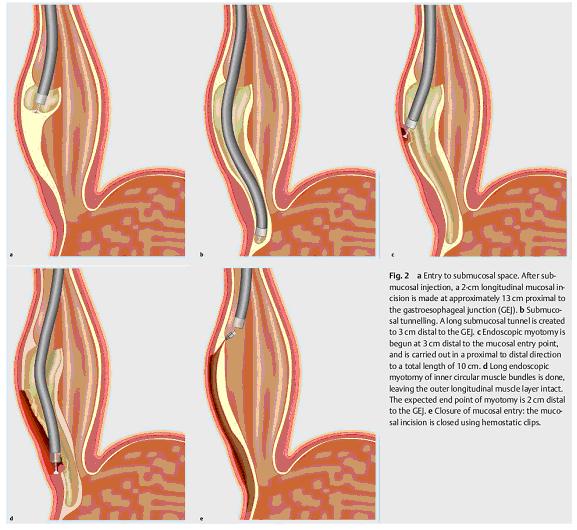 Per Orale Endoscopische Myotomie